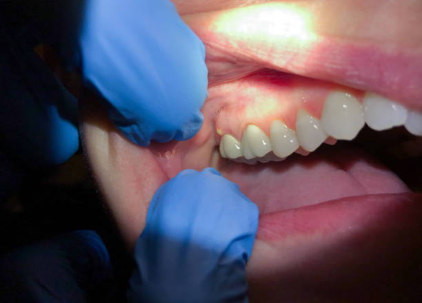 Best Emergency Treatment for Dental Infections or Abscesses in Helena West Side, MT