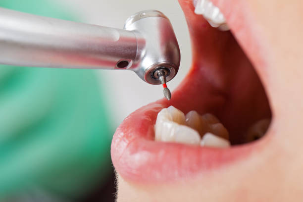 Best Emergency Dental Care for Broken or Chipped Teeth in Helena West Side, MT